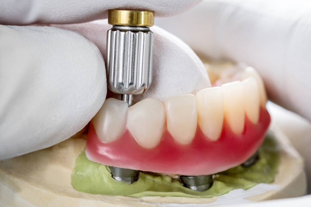 A Dental Implants [object object] - A Dental Implants - GPA Dental Group | Dental Clinic Singapore
