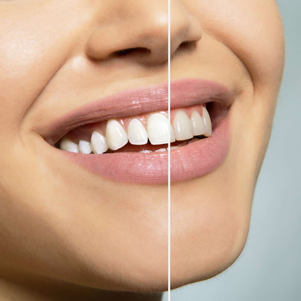 Before And After Teeth Whitening [object object] - Before And After Teeth Whitening - GPA Dental Group | Dental Clinic Singapore