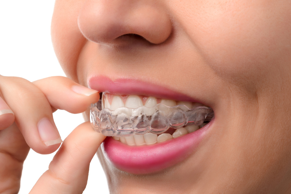 Woman Wearing Orthodontic Silicone Trainer [object object] - Woman Wearing Orthodontic Silicone Trainer - GPA Dental Group | Dental Clinic Singapore