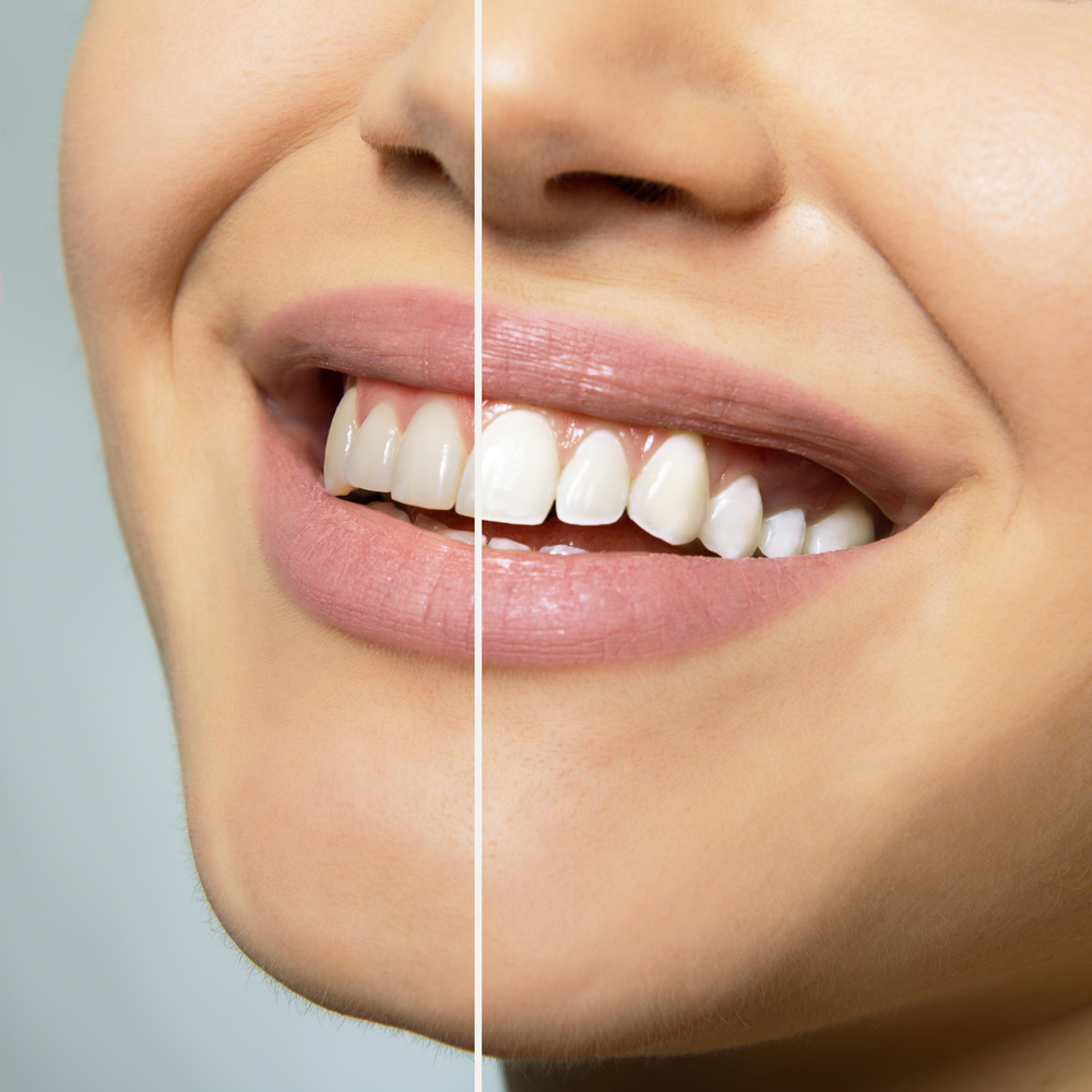- 738787810 - Reasons Why You Should Consider Teeth Whitening