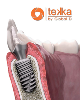 tekka implants our science - tekka implants - Our Science